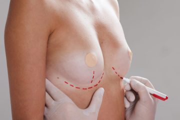 Reafirmación mamaria tras el embarazo sin cicatrices visibles