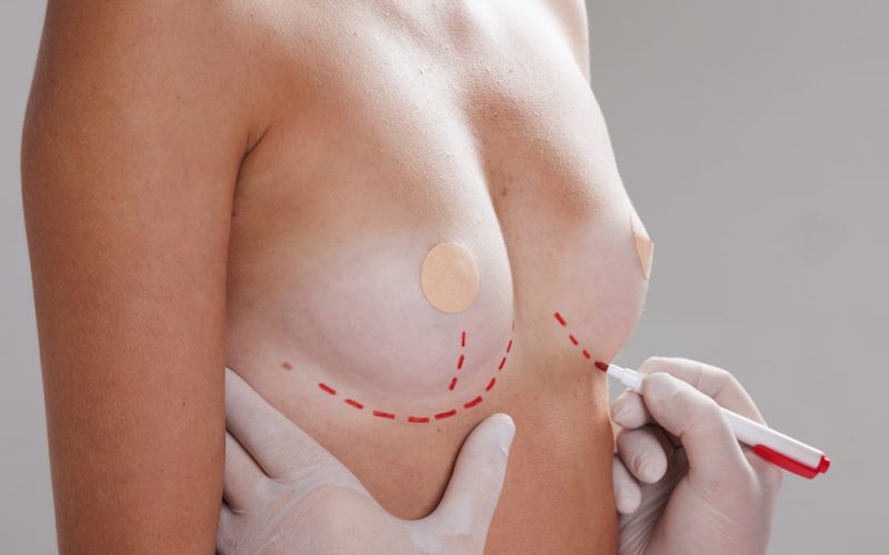 Reafirmación mamaria tras el embarazo sin cicatrices visibles